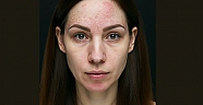Kışın Yüzünüzdeki Kızarıklık ve Kuruma İçin Önemli İpuçları: Seboreik Dermatiti Anlamak ve Yönetmek